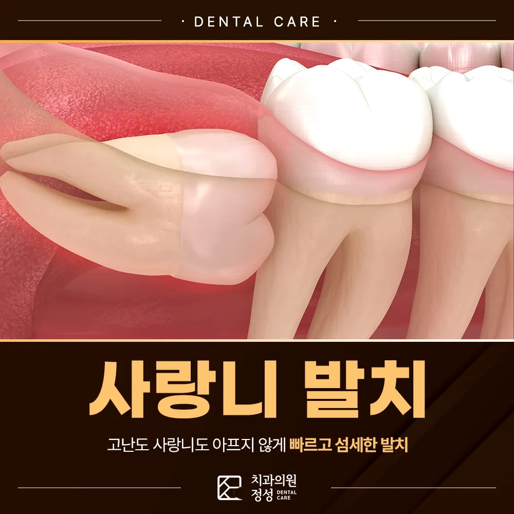 정성치과 사랑니발치, 매복 상태와 주변 구조 확인이 먼저입니다