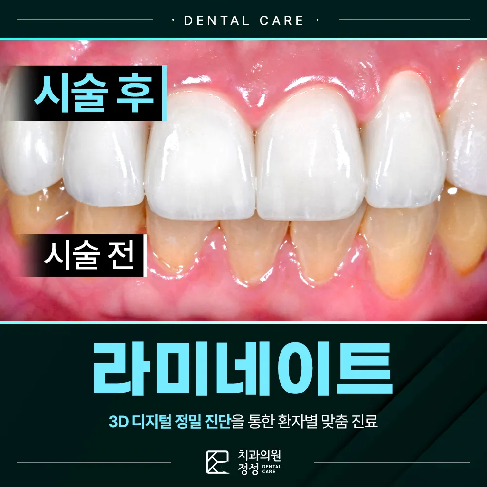 정성치과 라미네이트, 치아 상태와 적용 범위를 먼저 확인해야 합니다