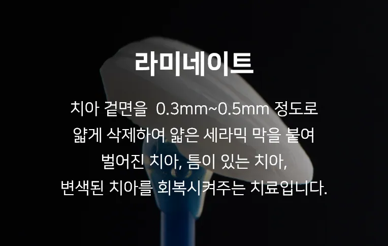 안양치과 정성치과의원 보철치료