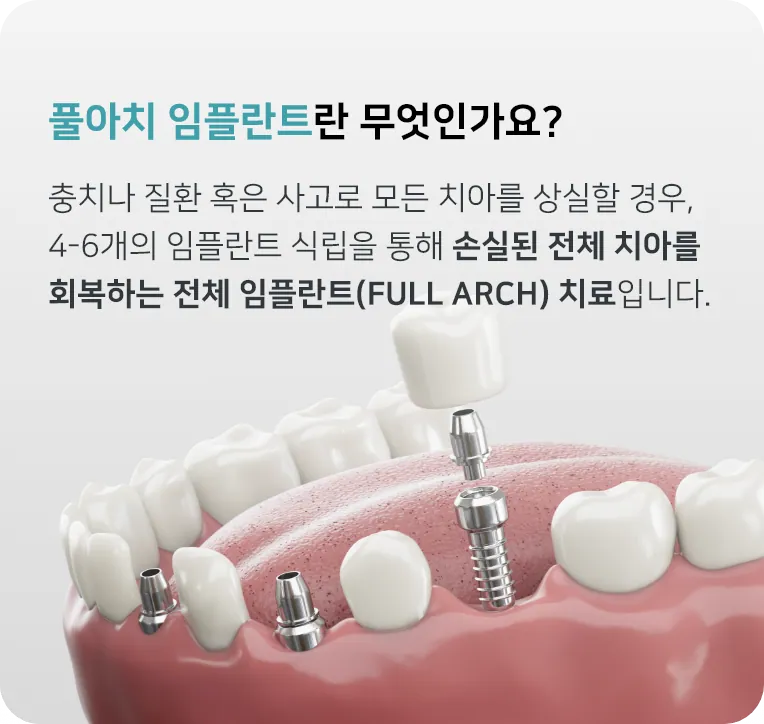 범계역 안양정성치과 임플란트