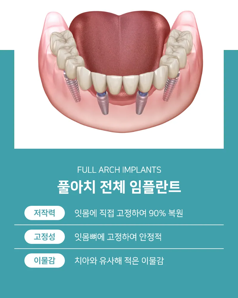 범계역 안양정성치과 임플란트
