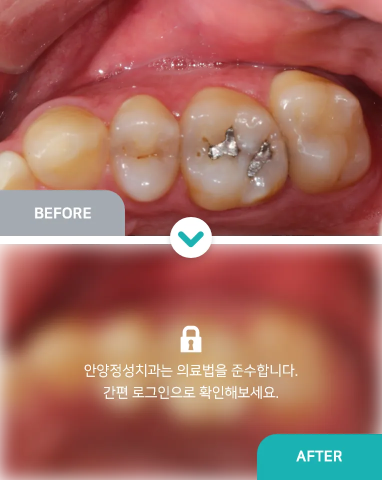 안양치과 정성치과의원 치료케이스