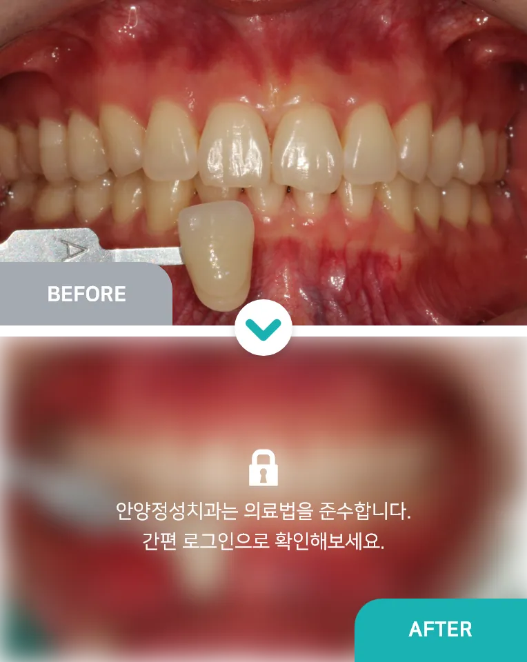 안양치과 정성치과의원 치료케이스