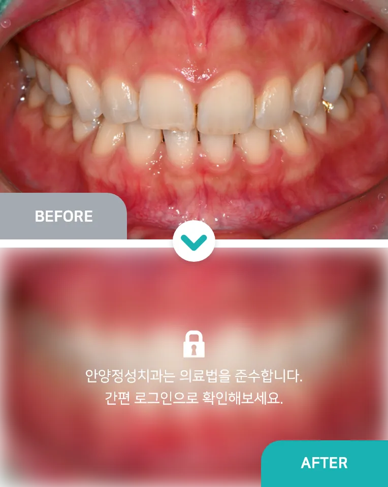안양치과 정성치과의원 치료케이스