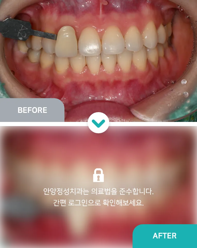 안양치과 정성치과의원 치료케이스