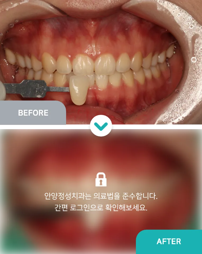 안양치과 정성치과의원 치료케이스