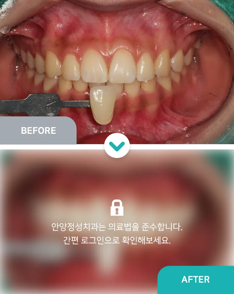 안양치과 정성치과의원 치료케이스
