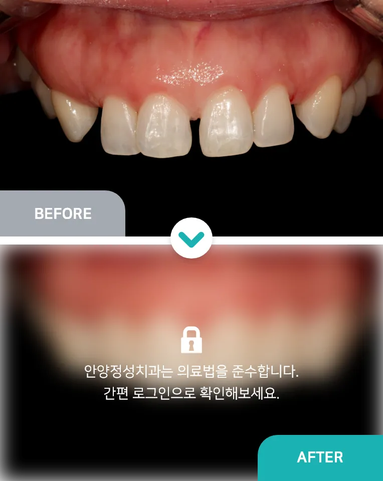 안양치과 정성치과의원 치료케이스