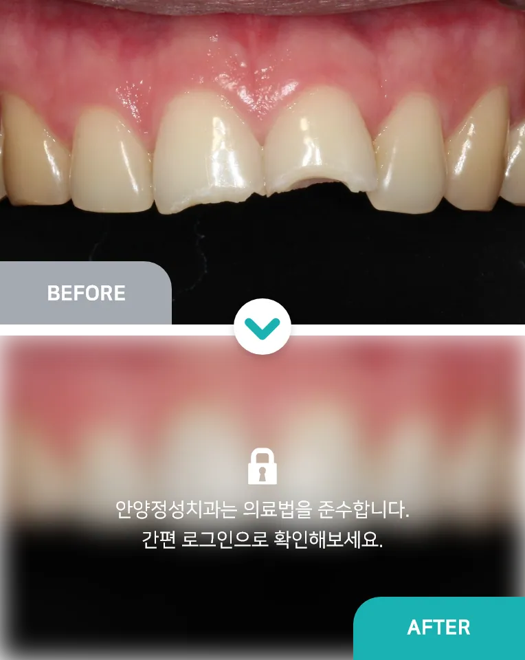 안양치과 정성치과의원 치료케이스