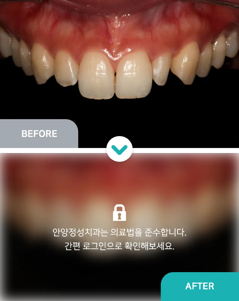 안양치과 정성치과의원 치료케이스