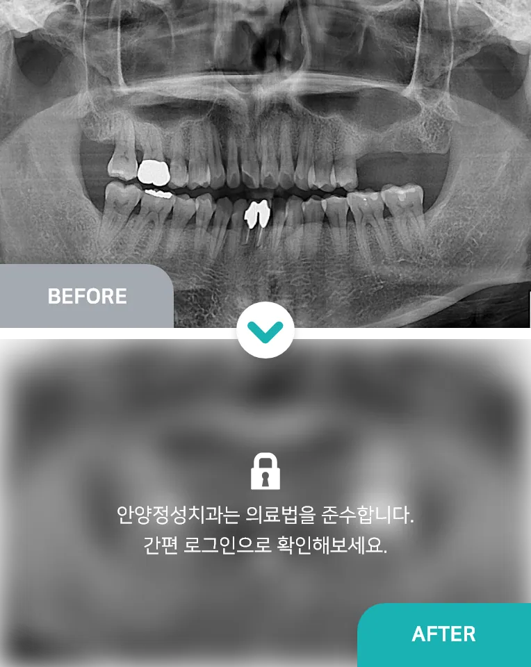 안양치과 정성치과의원 치료케이스