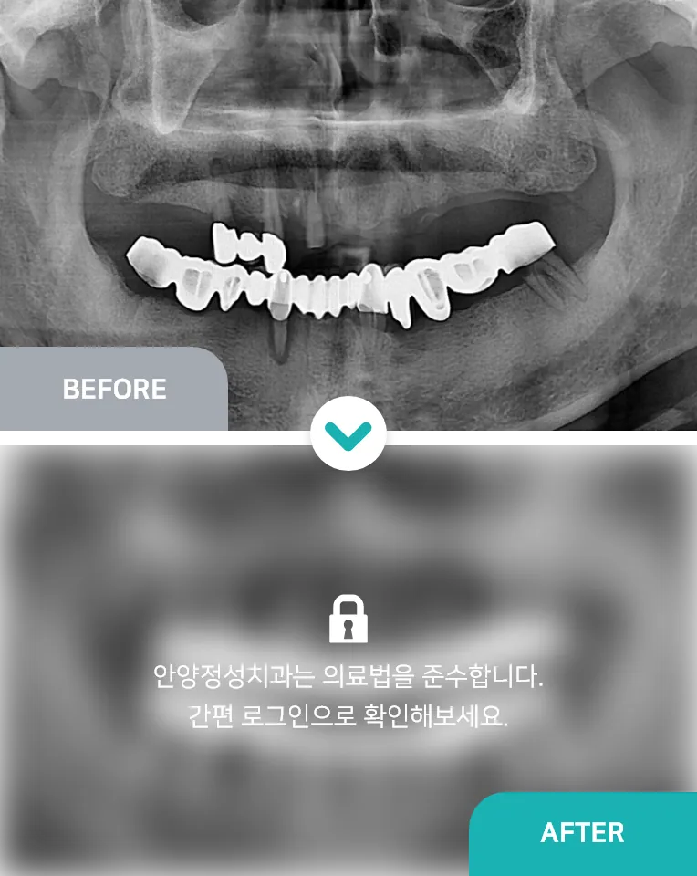 안양치과 정성치과의원 치료케이스