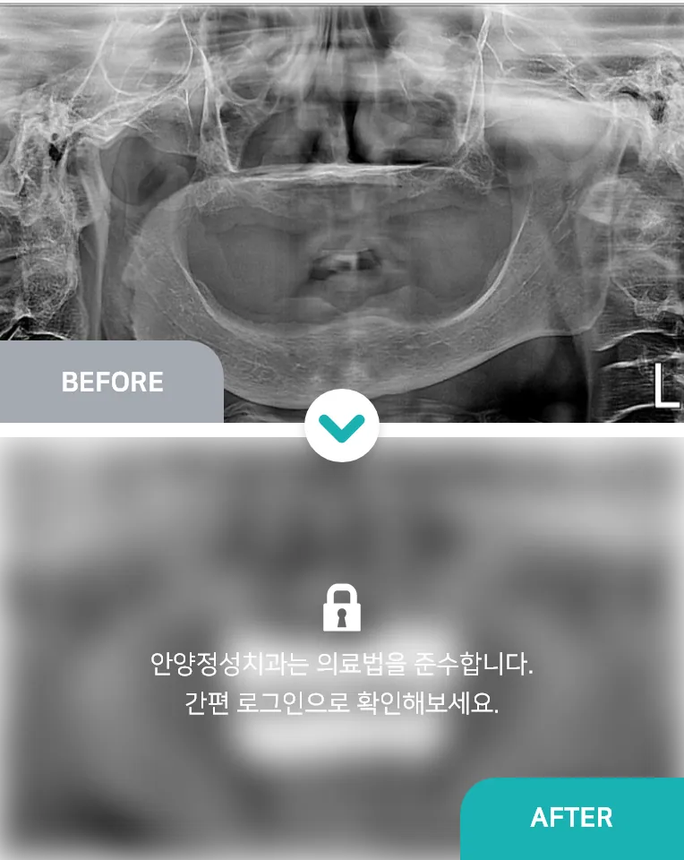 안양치과 정성치과의원 치료케이스