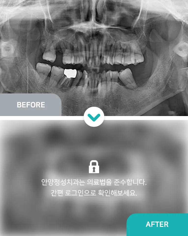 안양치과 정성치과의원 치료케이스