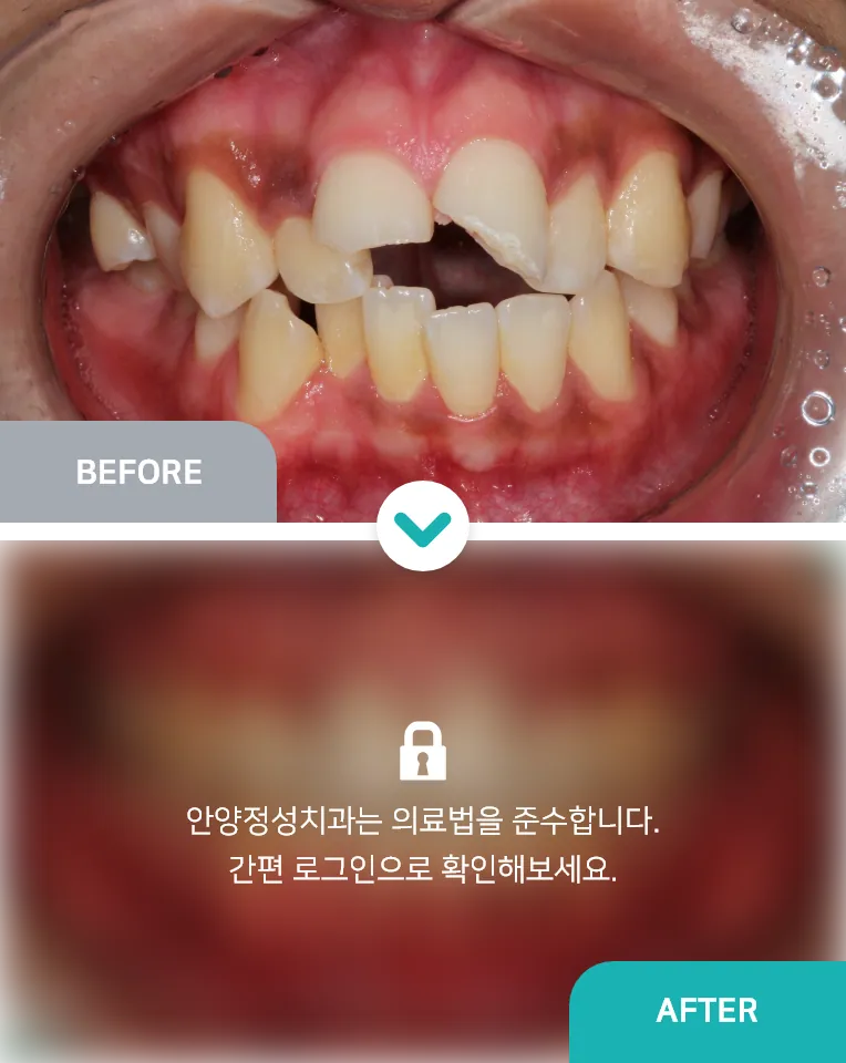 안양치과 정성치과의원 치료케이스