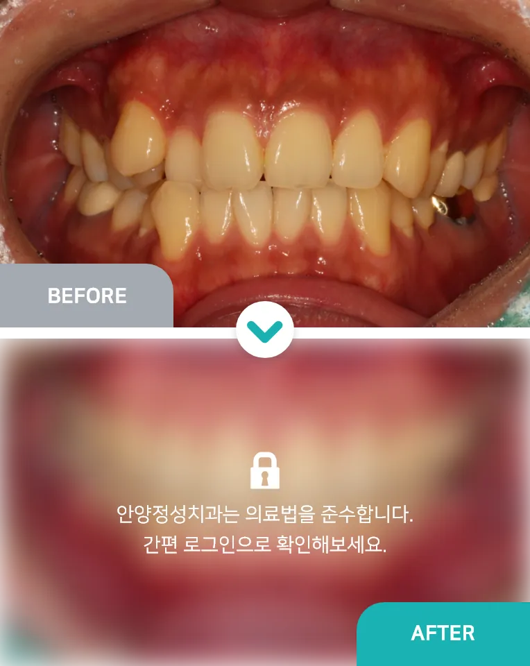 안양치과 정성치과의원 치료케이스