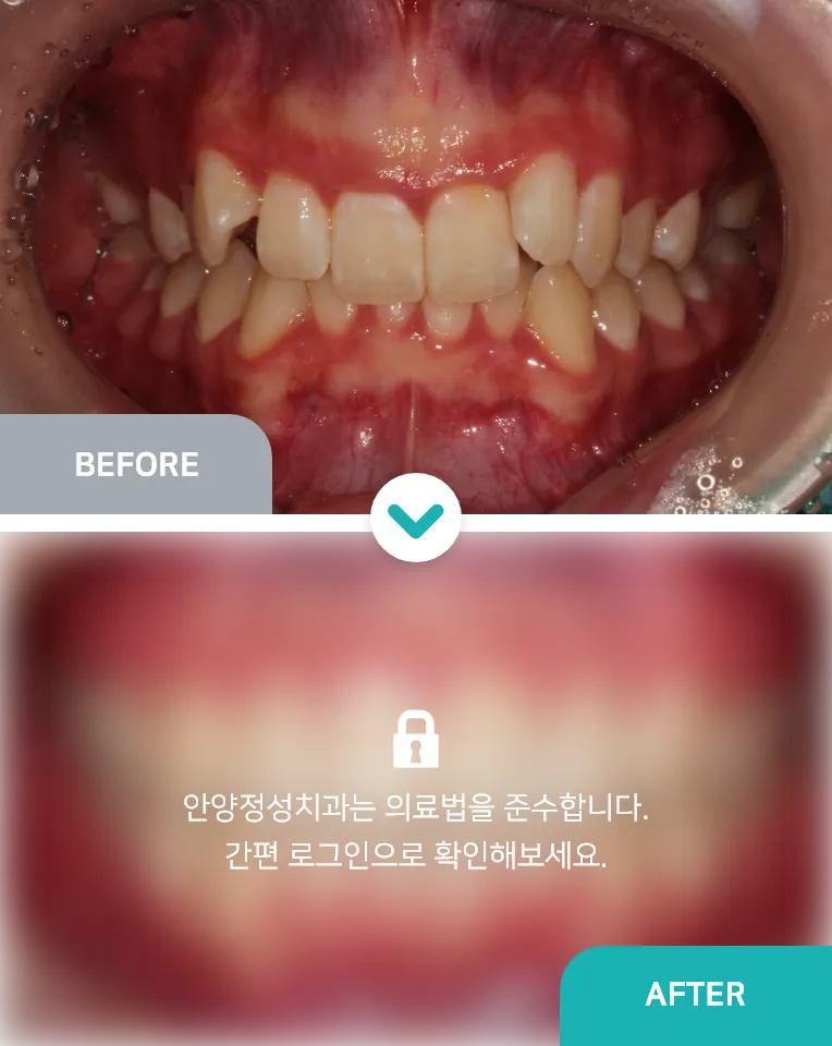 안양치과 정성치과의원 치료케이스