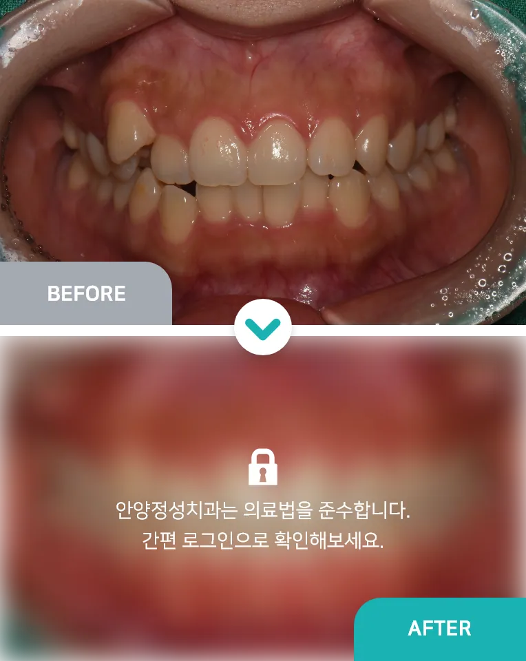 안양치과 정성치과의원 치료케이스