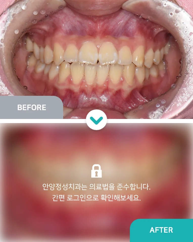 안양치과 정성치과의원 치료케이스